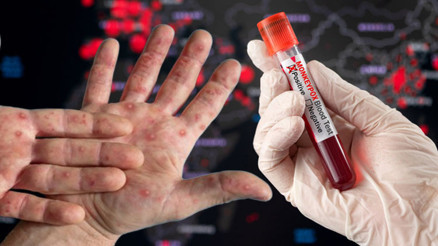 M-Çiçeği salgını büyüyor Aşılar tam koruma sağlıyor mu Önceki çiçek aşıları virüse karşı ne kadar etkili ‘Durum çok acil, binlerce kişi korunmasız kalabilir’ M-Çiçeği salgını büyüyor Aşılar tam koruma sağlıyor mu Önceki çiçek aşıları virüse karşı ne kadar etkili ‘Durum çok acil, binlerce kişi korunmasız kalabilir’