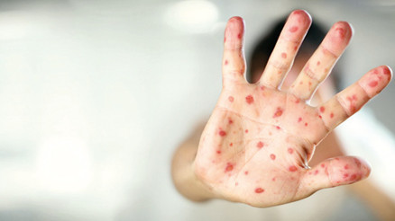 Bakan’dan maymun çiçeği açıklaması: Türkiye’de vaka yok