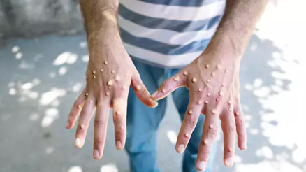 Ankara İl Sağlık Müdürlüğünden iddialara yalanlama: Mpox karantinası yok Ankara İl Sağlık Müdürlüğünden iddialara yalanlama: Mpox karantinası yok