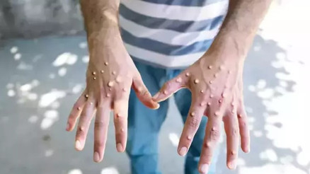 Ankara İl Sağlık Müdürlüğü: Mpox karantinası yok Ankara İl Sağlık Müdürlüğü: Mpox karantinası yok