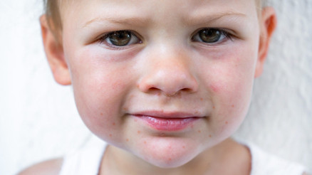 Dikkat Vakalar arttı hastaneler doldu El ayak ağız hastalığı nasıl bulaşır, nasıl önlenir