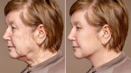 Yeni trend: Ameliyatsız yüz germe işlemi… ‘Uygulamadan bir saat sonra cildim adeta yenilendi’ Yeni trend: Ameliyatsız yüz germe işlemi… ‘Uygulamadan bir saat sonra cildim adeta yenilendi’