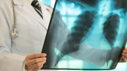 Dünyanın en ölümcül enfeksiyonu olan tüberkülozda artış rapor edildi Peki Türkiye’de durum ne