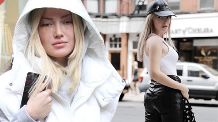 Danla Bilicin estetik pişmanlığı Kalçamdaki dolgu kaburgama çıktı