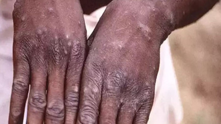 Afrika ülkesinde Maymun çiçeği alarmı: Acil durum ilan edildi