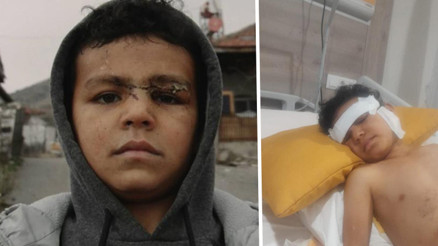 5 yaşındaki çocuk sokak köpeğinin saldırısına uğradı; yüzünde ısırık izleri oluştu