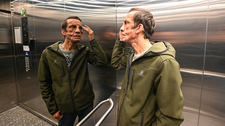 Türkiyede ilk kez yüz nakli olmuştu Hayatı bir ameliyatla değişti: Organ bağışıyla hayalleri gerçek oldu