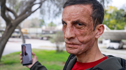 Türkiyenin ilk yüz nakli ona yapılmıştı... Donörün kızı ile duygulandıran görüşme: Babamın yüzü Uğurda yaşıyor Türkiyenin ilk yüz nakli ona yapılmıştı... Donörün kızı ile duygulandıran görüşme: Babamın yüzü Uğurda yaşıyor