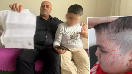 Otizmli öğrencinin vücudundaki morluklara savcılık soruşturması: Öğretmeni açığa alındı