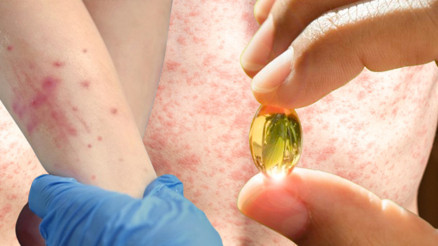 Kızamık vakaları artmaya başladı: A vitamini çözüm mü sunuyor Araştırma sonuçları kafaları karıştırdı…