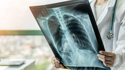 Kanserden koruyan 10 altın kural Kanserden koruyan 10 altın kural