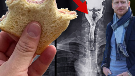 Sandviç yerken boğulma tehlikesi geçirdi, bu sayede kanser olduğunu öğrendi Şikâyetlerimi hep stresime bağladım