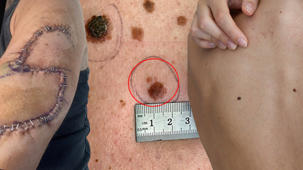 Arkadaşının dikkati sayesinde kanser olduğunu öğrendi, kolunun bir kısmı alındı | Hangi benler radarımızda olmalı Arkadaşının dikkati sayesinde kanser olduğunu öğrendi, kolunun bir kısmı alındı | Hangi benler radarımızda olmalı