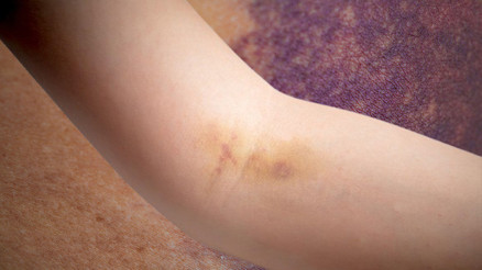 Yumrular, şişlikler, açıklanamayan kanamalar ve morluklar... Fark etmek çok kolay, ihmali ölümcül