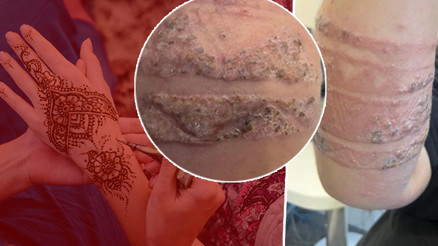 Zararsız sanılan tehlike: Tatil bölgelerinde çok sık tercih ediliyor ‘Beş dakika içinde müdahale edilmezse ölümle sonuçlanabilir’ Zararsız sanılan tehlike: Tatil bölgelerinde çok sık tercih ediliyor ‘Beş dakika içinde müdahale edilmezse ölümle sonuçlanabilir’