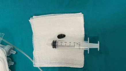 Akciğerine çekirdek kabuğu kaçtı 15 aylık bebek acil müdahaleyle kurtarıldı