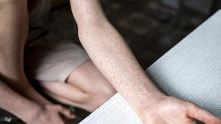 ABDde kızamık salgını: Vakalar son 33 yılın en yüksek seviyesinde