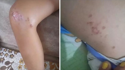 Gazipaşa’da 9 yaşındaki çocukta deniz kaynaklı enfeksiyon şüphesi Gazipaşa’da 9 yaşındaki çocukta deniz kaynaklı enfeksiyon şüphesi