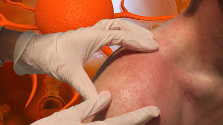 Gençlerde cilt kanseri vakaları artıyor Yanlış güneş kremi kullanımının etkisi büyük… Uzmanlar 13 kritik soruya cevap verdi