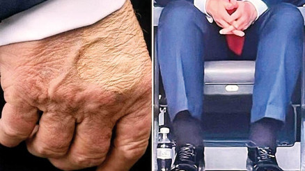 Morlukların sebebi belli oldu… Trump’ta kronik hastalık çıktı