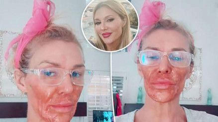 ‘Yüzüm eriyip gitti, perişanım’ diyordu… Hem parası tükendi hem de kendi kendine tedavi olmaya çalışınca suratı kavruldu