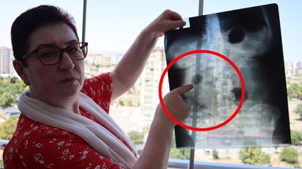 Hastanede hayatının şokunu yaşadı 22 yıldır karnında: Canlı bomba gibi geziyorum