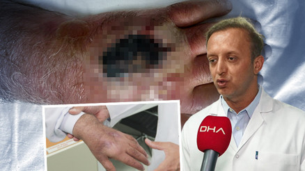 İnsan ısırığının şiddetini gördük | İstanbulda doktorları bile şaşkına çeviren olay: Literatüre girecek