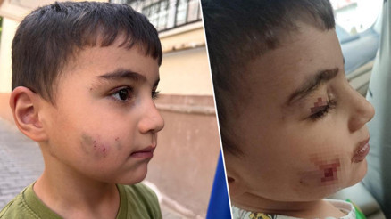 Ankarada korkunç olay Evinde uyuyan çocuğu lağım faresi ısırdı