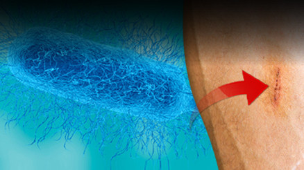 Sinsi tehlike: Et yiyen bakteri can alıyor, vaka sayıları arttı Küçük bir çizik neredeyse hayatına mâl olacaktı