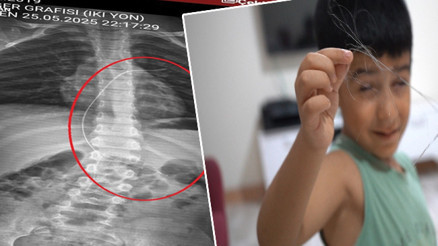Salatalık parçası yuttu hastaneye gitti Çekilen röntgenle ortaya çıktı 18 santimetrelik kateter unutulmuş