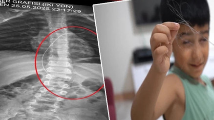 Salatalık parçası yuttu hastaneye gitti Çekilen röntgenle ortaya çıktı