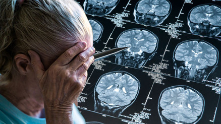 Alzheimer tarih mi oluyor Bu yıl öğrendiğimiz şaşırtıcı derecede umut veren beş şey Alzheimer tarih mi oluyor Bu yıl öğrendiğimiz şaşırtıcı derecede umut veren beş şey