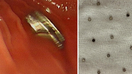 Küçük çocuk 19 tanesini birden yuttu: Hastanedeki operasyonla çıkarıldı