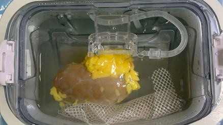 Organ naklinde bir ilk: Böbreğin kan grubu değiştirildi Organ naklinde bir ilk: Böbreğin kan grubu değiştirildi