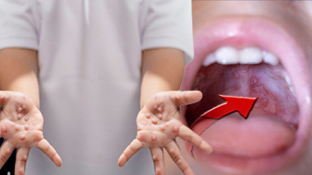 Aşısı yok, antibiyotik işe yaramıyor | Vakalardaki artış normal mi Bazı virüs tipleri menenjit veya kalp kası iltihabına yol açabilir Aşısı yok, antibiyotik işe yaramıyor | Vakalardaki artış normal mi Bazı virüs tipleri menenjit veya kalp kası iltihabına yol açabilir