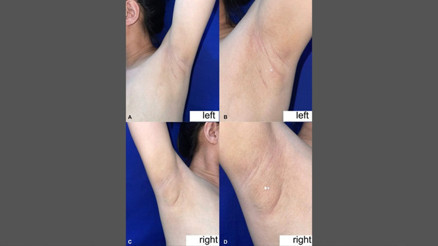 Filipinli kadının koltukaltından süt geldi: Nadir görülen durumun nedeni ne