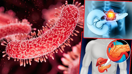 Mikrobiyota haritasında yeni bir sayfa açıldı, pankreas mikrobiyotası keşfedildi Kanserle savaşta yeni umut olacak