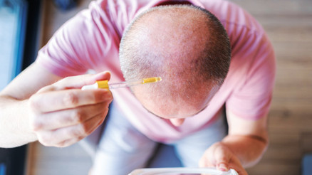 Dünya bu ilacı konuşuyor: Kelliğe merhem umudu