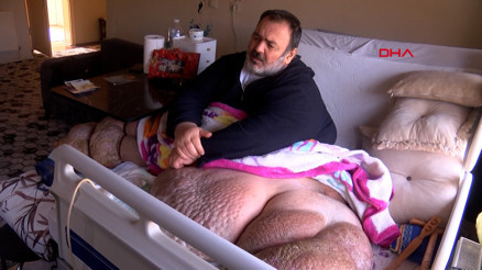 5 yıldır evden çıkamayan 300 kiloya ulaşan fil hastasının hayali; eşiyle kol kola caddede gezmek