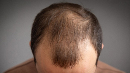 Saç dökülmesi neden olur Saç dökülmesine ne iyi gelir