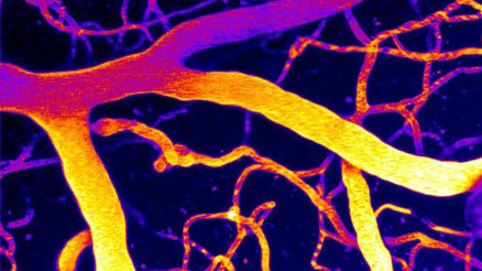 Demansa karşı umut: PIP2 Demansa karşı umut: PIP2