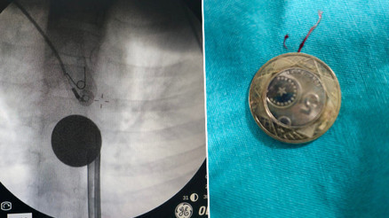 8 yaşındaki çocuk madeni para yuttu