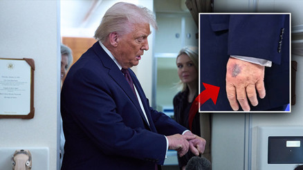 Trump elindeki morluğun sebebini açıkladı