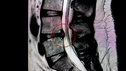 Modern yöntemler kurtarıyor ama dikkat Bel fıtığı kâbus olmasın: 9 hayati önlem