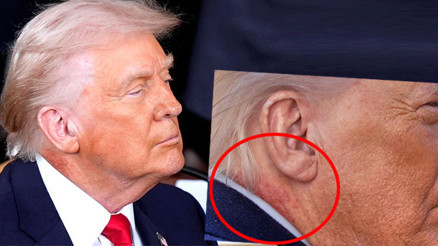 Trump’ın boynuna ne oldu Kanser tedavisi mi görüyor