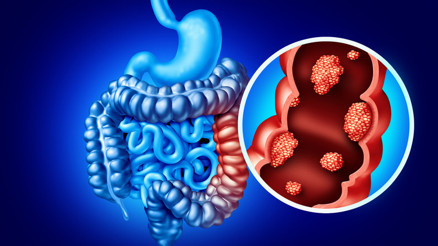 Mart ayı Kolorektal Kanser Farkındalık Ayı: Erken tanı tedavi yaklaşımını nasıl değiştirir Mart ayı Kolorektal Kanser Farkındalık Ayı: Erken tanı tedavi yaklaşımını nasıl değiştirir