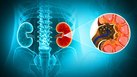 Böbrek taşı düşüren bir kişi nelere dikkat etmeli