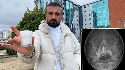 5 yaşındaki Polen, 2 yıldır burnunda tırnak makası zinciriyle yaşamış