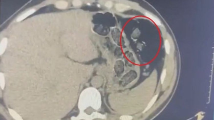Midelerinden uyuşturucuyla yakalanan 2 şüpheli tutuklandı
