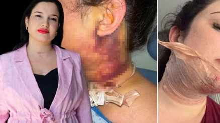 Estetik ameliyatı sonrası yoğun bakımda 2 gün tedavi gördü, doktor hakkında şikayetçi oldu Estetik ameliyatı sonrası yoğun bakımda 2 gün tedavi gördü, doktor hakkında şikayetçi oldu